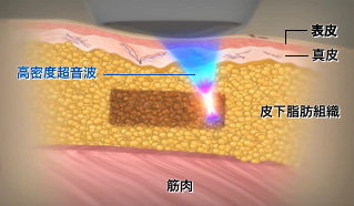 ライポソニックス 高密度焦点式超音波で皮膚を傷つけずお腹周りの脂肪細胞を破壊 五本木クリニック