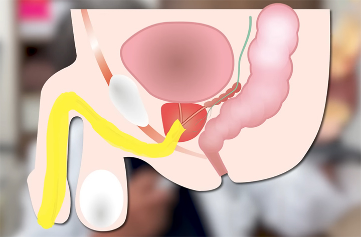 前立腺肥大は日帰り手術で完治する おしっこの悩みからガンの不安まで ...