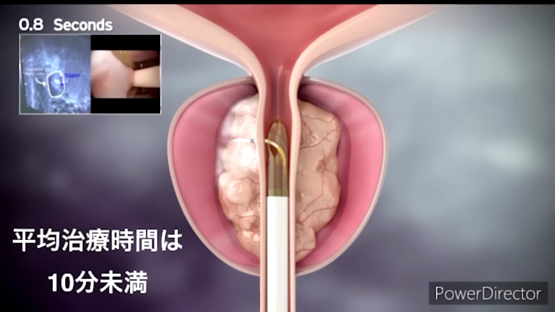 前立腺肥大は日帰り手術で完治する おしっこの悩みからガンの不安まで ...