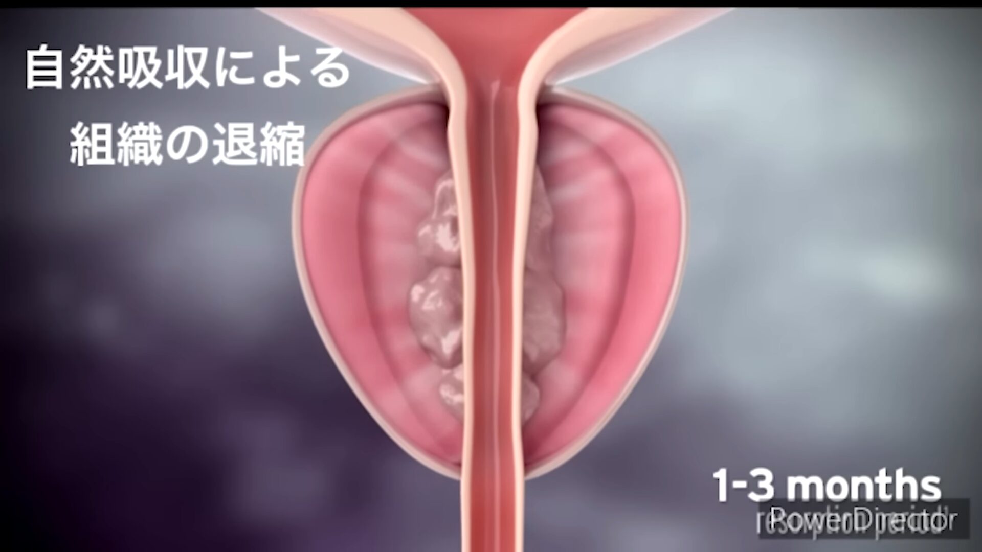 前立腺肥大は日帰り手術で完治する おしっこの悩みからガンの不安まで ...