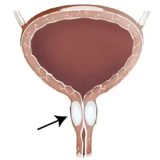 尿道周囲注入術（periurethral injection of bulking agent）